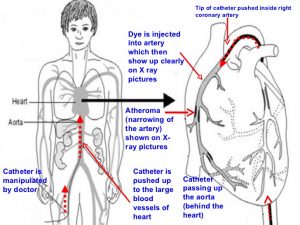 Coronary angiography